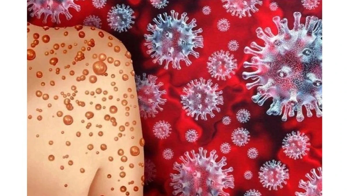 Mokso e COVID: Delle malattie che sembrano simili ma sono profondamente diverse